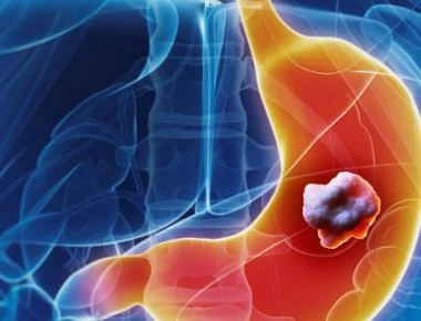 Οι δέκα εντολές για την πρόληψη του καρκίνου - Πώς θα προστατευθείτε